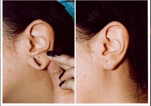 Earlobe Repair Treatment