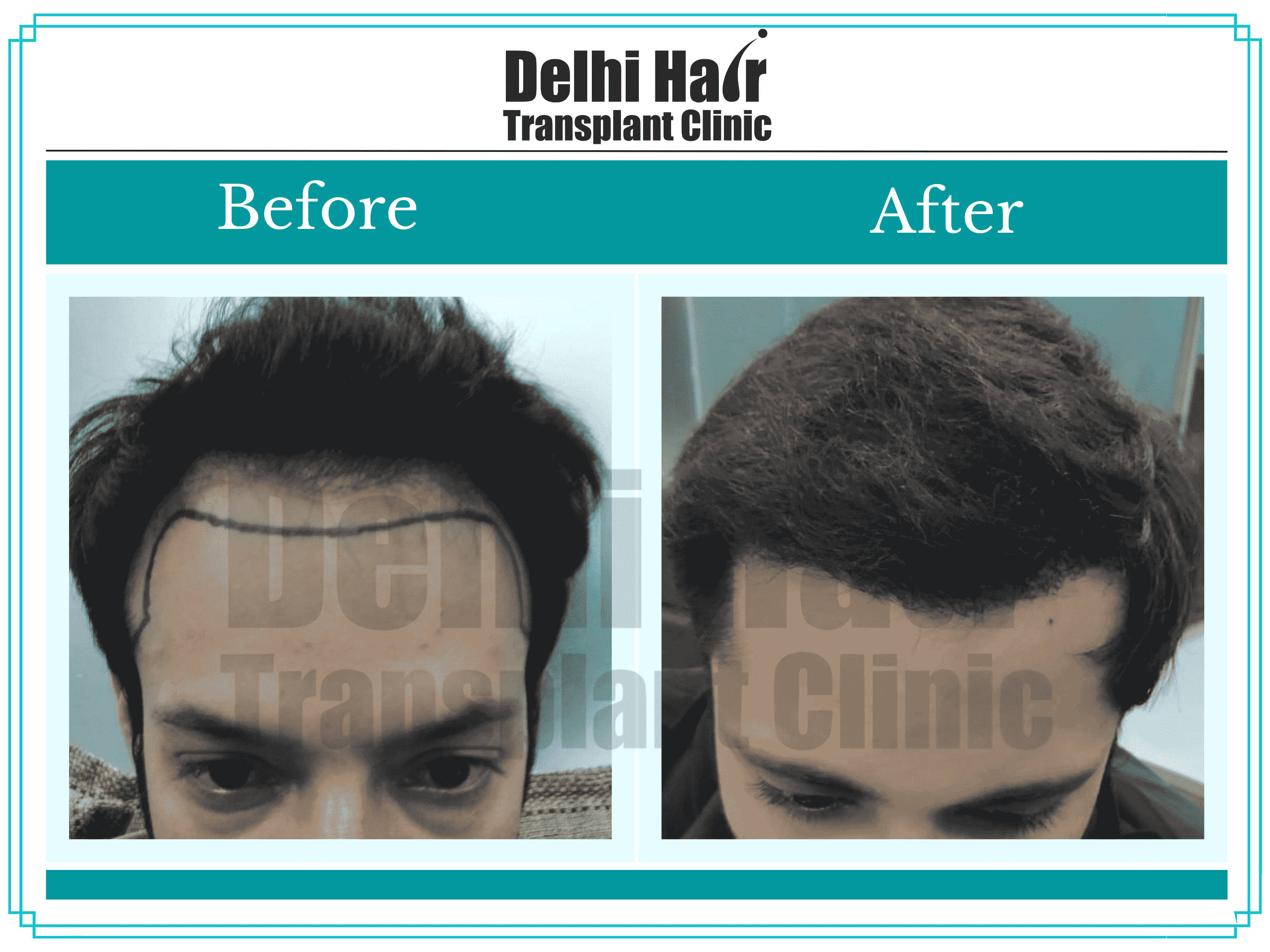 Best Hair Transplant Surgeon